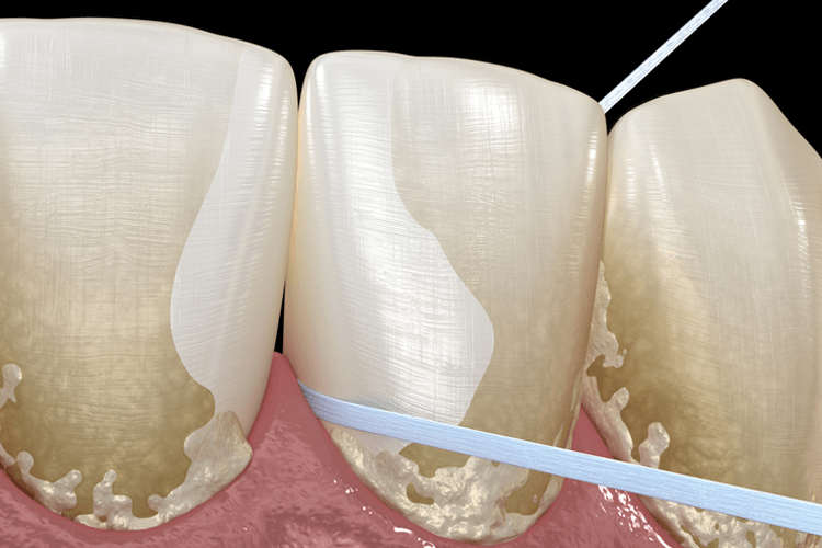 study shows Flossing daily can decrease your risk of various cancers by up to 68%